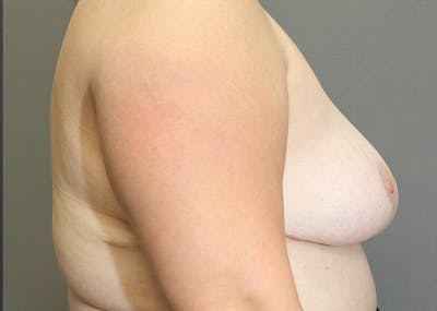 Breast Reduction Before & After Gallery - Patient 148648435 - Image 10