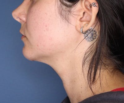 Chin Implant Before & After Gallery - Patient 148679396 - Image 2