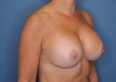 Breast Augmentation Before & After Gallery - Patient 168961010 - Image 4