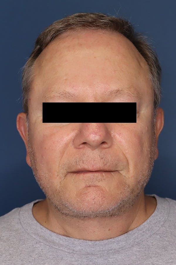 Neck Lift Before & After Gallery - Patient 189382472 - Image 6