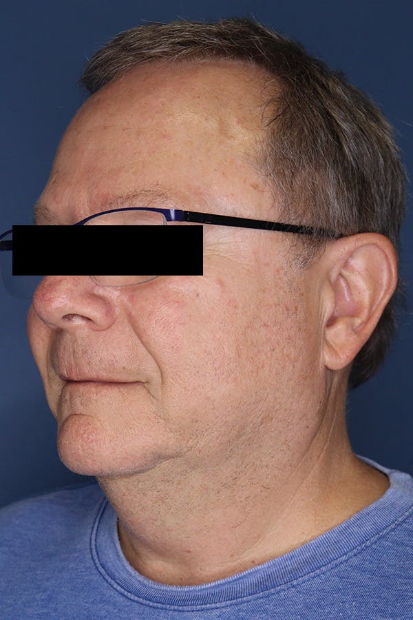 Neck Lift Before & After Gallery - Patient 189382472 - Image 3