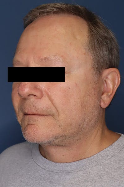 Neck Lift Before & After Gallery - Patient 189382472 - Image 4
