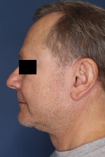 Neck Lift Before & After Gallery - Patient 189382472 - Image 2