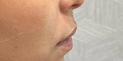 Lip Filler Before & After Gallery - Patient 99750493 - Image 1