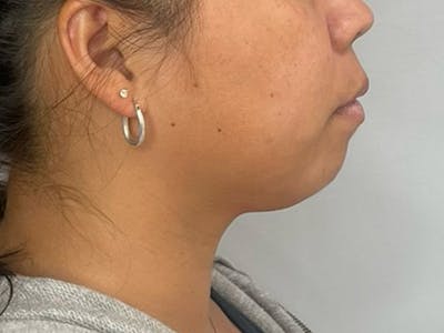 Chin Filler Before & After Gallery - Patient 190615591 - Image 1