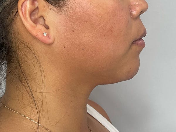 Chin Filler Before & After Gallery - Patient 190615591 - Image 2