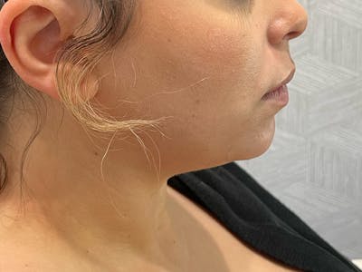 Chin Filler Before & After Gallery - Patient 190615592 - Image 1