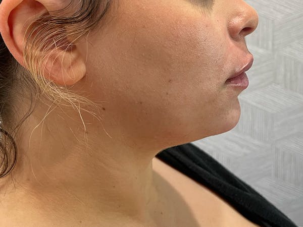 Chin Filler Before & After Gallery - Patient 190615592 - Image 2