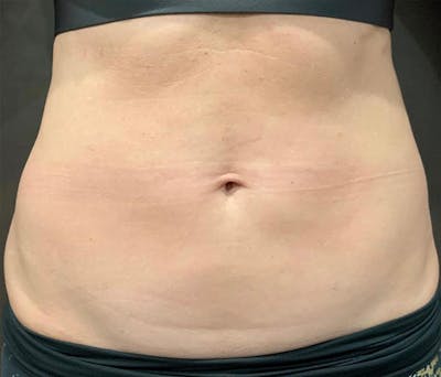 Microcannula Liposuction Before & After Gallery - Patient 191400310 - Image 2