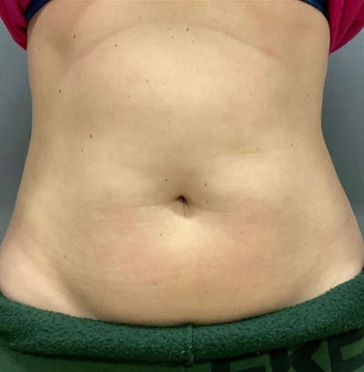 Microcannula Liposuction Before & After Gallery - Patient 26868844 - Image 1