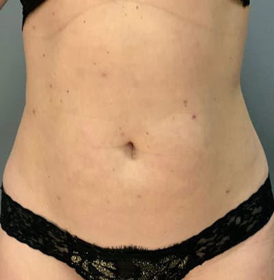 Microcannula Liposuction Before & After Gallery - Patient 26868844 - Image 2
