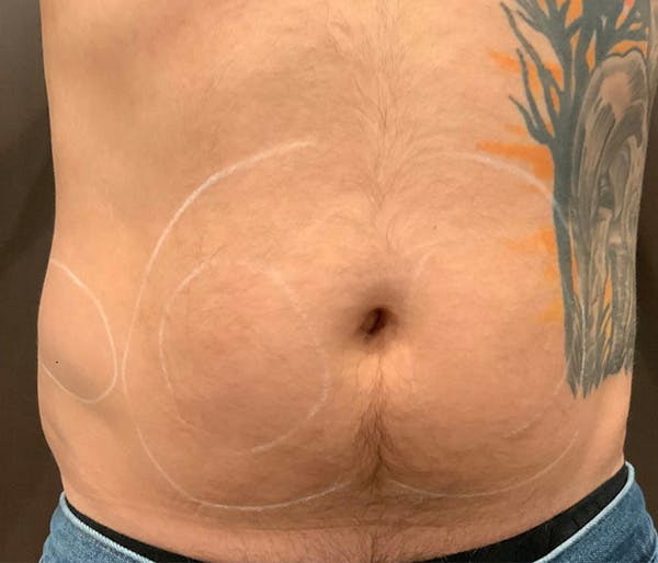Microcannula Liposuction Before & After Gallery - Patient 191403616 - Image 1