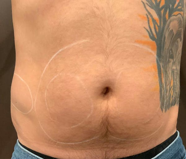 Microcannula Liposuction Before & After Gallery - Patient 191403616 - Image 1
