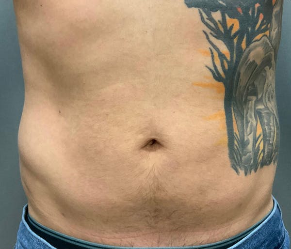 Microcannula Liposuction Before & After Gallery - Patient 191403616 - Image 2