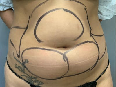 Microcannula Liposuction Before & After Gallery - Patient 191404285 - Image 1