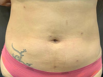 Microcannula Liposuction Before & After Gallery - Patient 191404285 - Image 2