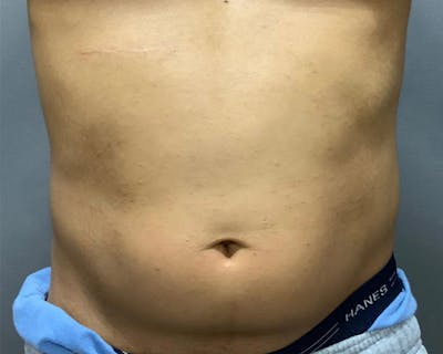 Microcannula Liposuction Before & After Gallery - Patient 191948872 - Image 1