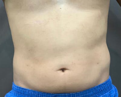 Microcannula Liposuction Before & After Gallery - Patient 191948872 - Image 2