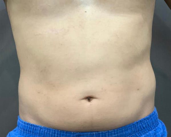 Microcannula Liposuction Before & After Gallery - Patient 191948872 - Image 2
