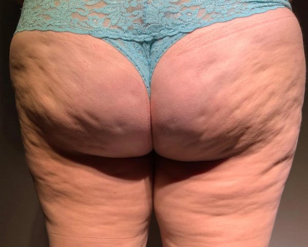 Microcannula Liposuction Before & After Gallery - Patient 191948875 - Image 1