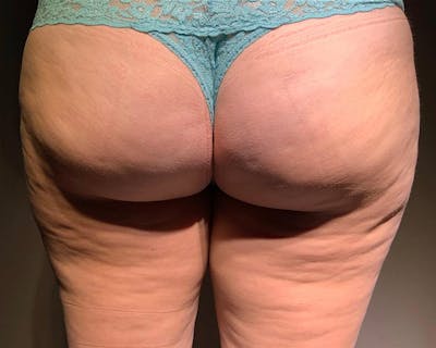 Microcannula Liposuction Before & After Gallery - Patient 191948875 - Image 2