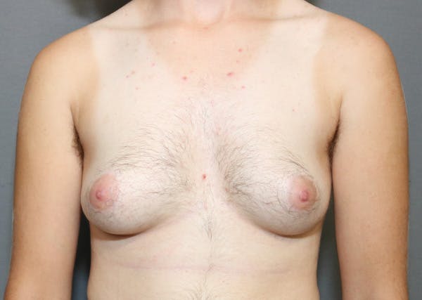 Top Surgery Before & After Gallery - Patient 325435 - Image 1