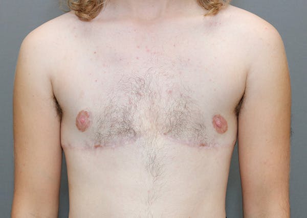 Top Surgery Before & After Gallery - Patient 325435 - Image 2