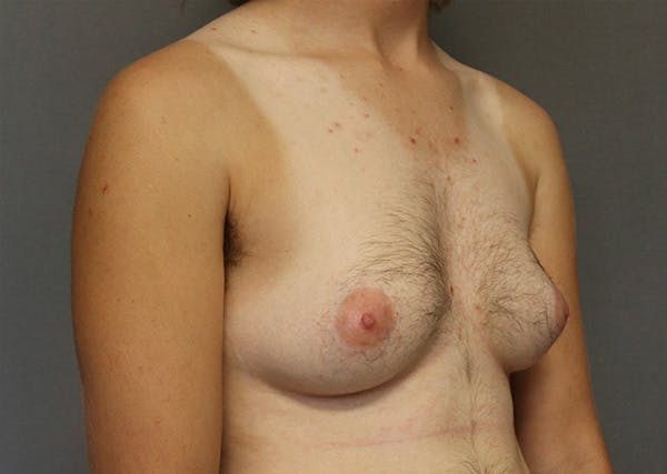 Top Surgery Before & After Gallery - Patient 325435 - Image 3