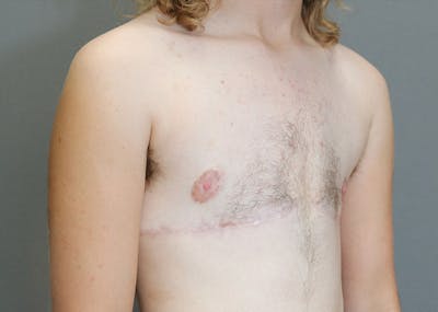 Top Surgery Before & After Gallery - Patient 325435 - Image 4