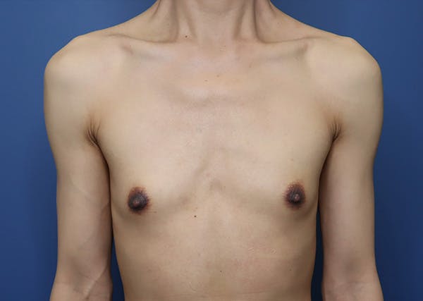 Top Surgery Before & After Gallery - Patient 215477 - Image 2