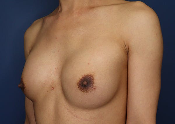 Top Surgery Before & After Gallery - Patient 215477 - Image 3