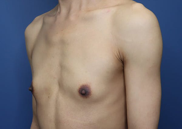 Top Surgery Before & After Gallery - Patient 215477 - Image 4