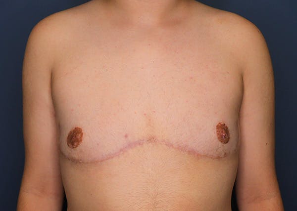 Top Surgery Before & After Gallery - Patient 113205 - Image 2