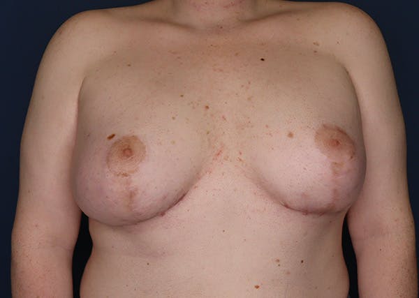 Breast Augmentation Before & After Gallery - Patient 107423 - Image 2