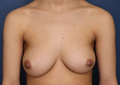 Top Surgery Before & After Gallery - Patient 521832 - Image 1