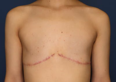 Top Surgery Before & After Gallery - Patient 521832 - Image 2