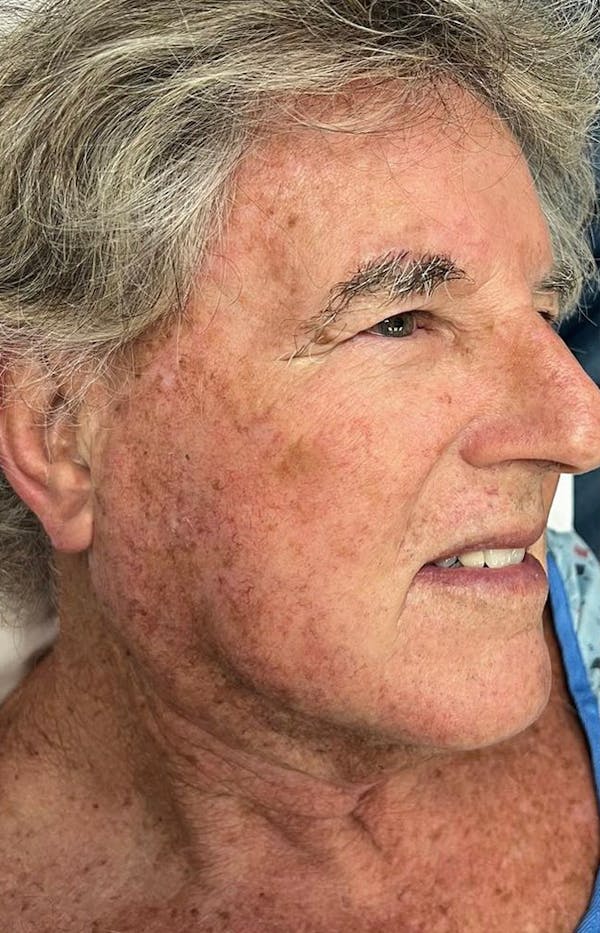Halo Skin Resurfacing Before & After Gallery - Patient 379244 - Image 3