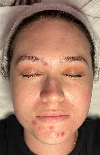 Acne Treatment Before & After Gallery - Patient 179267 - Image 1