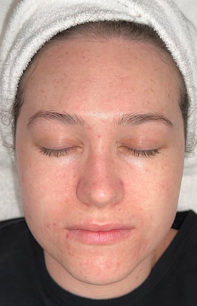 Acne Treatment Before & After Gallery - Patient 179267 - Image 2