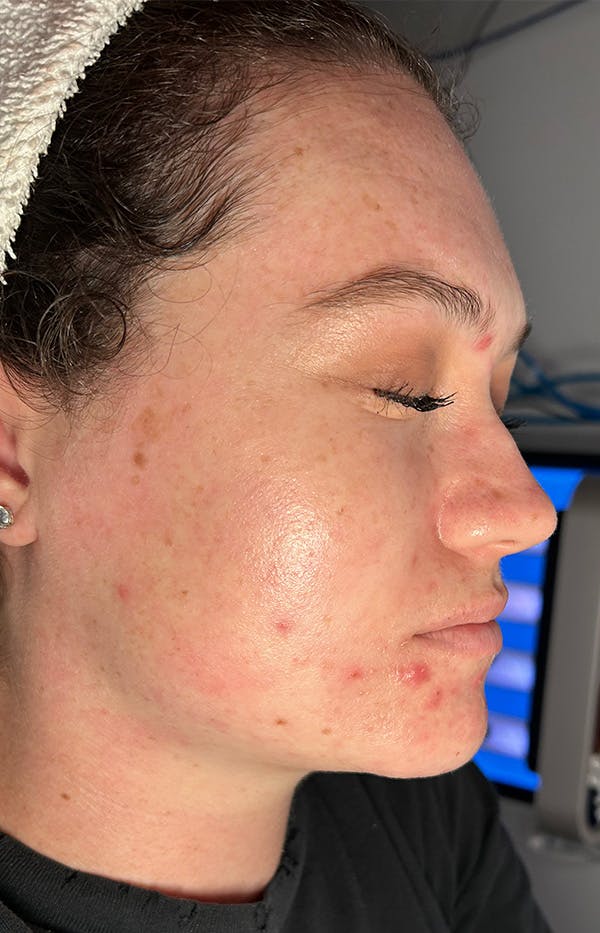 Acne Treatment Before & After Gallery - Patient 179267 - Image 3