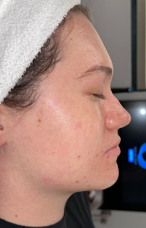 Acne Treatment Before & After Gallery - Patient 179267 - Image 4