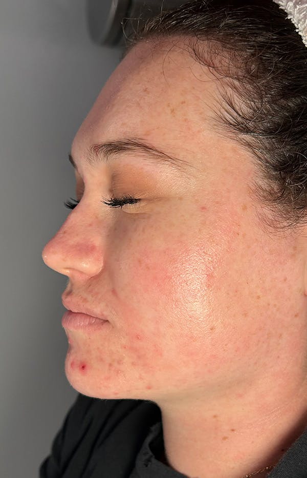 Acne Treatment Before & After Gallery - Patient 179267 - Image 5
