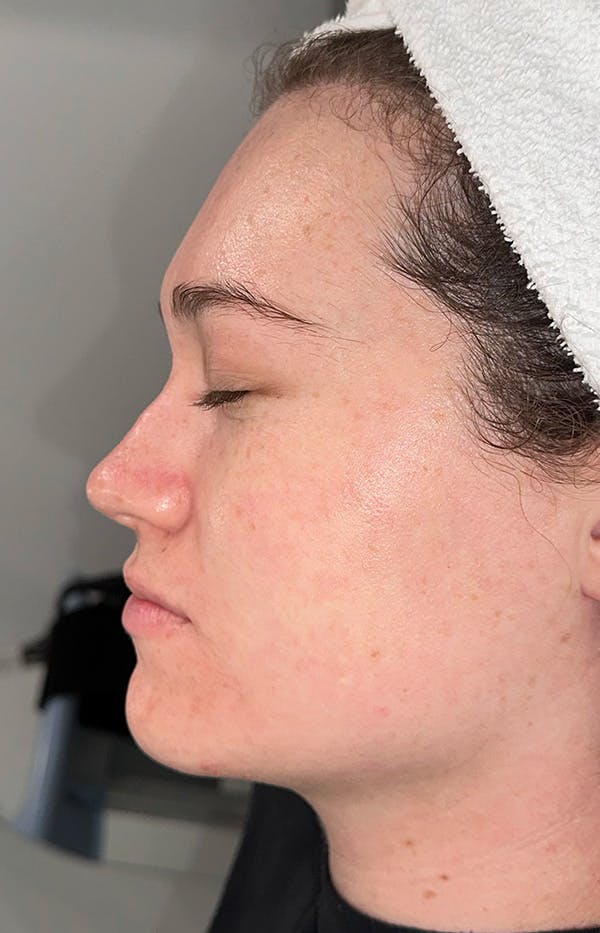 Acne Treatment Before & After Gallery - Patient 179267 - Image 6