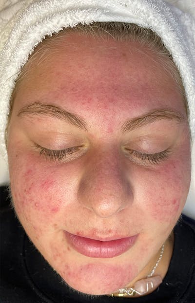 Acne Treatment Before & After Gallery - Patient 137678 - Image 1