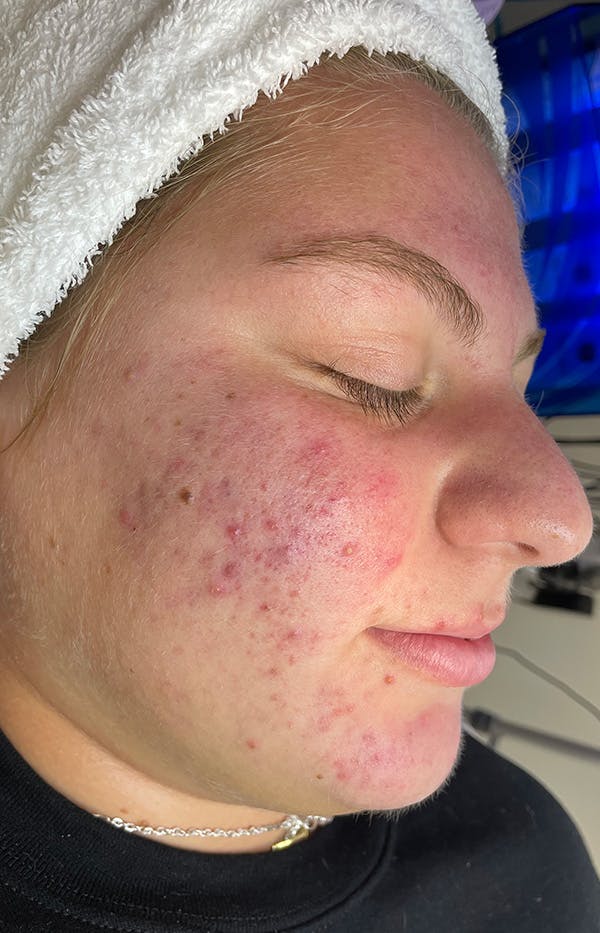 Acne Treatment Before & After Gallery - Patient 137678 - Image 3
