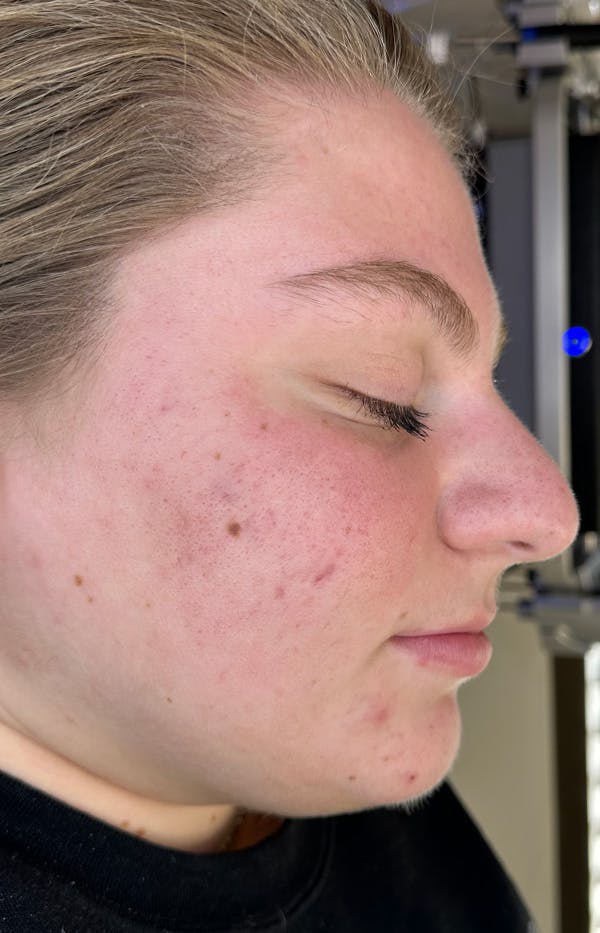 Acne Treatment Before & After Gallery - Patient 137678 - Image 4