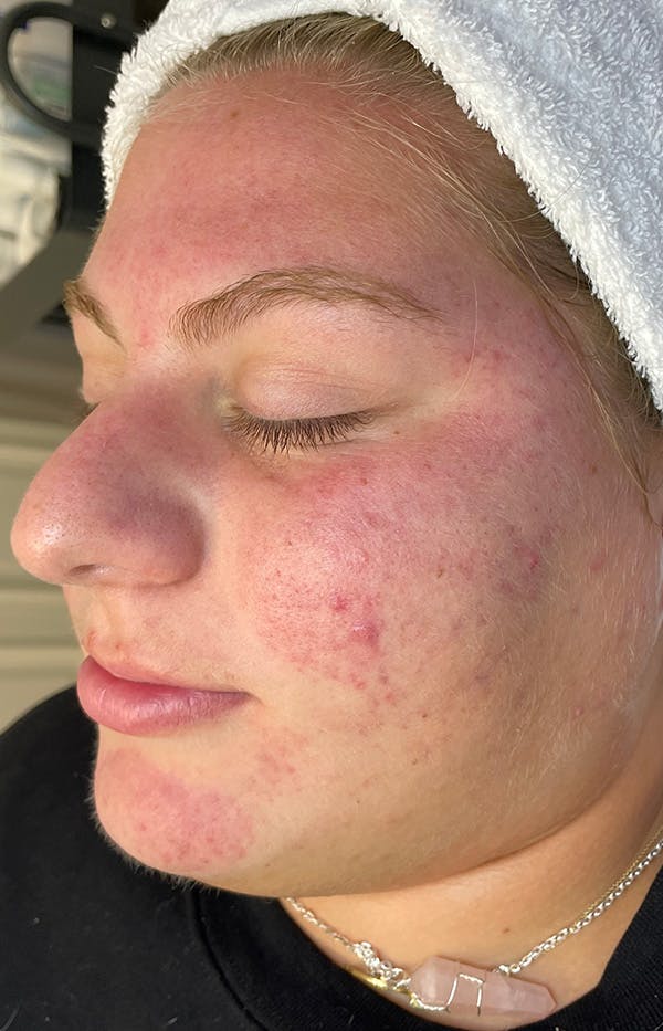 Acne Treatment Before & After Gallery - Patient 137678 - Image 5
