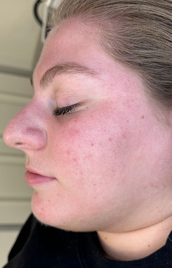 Acne Treatment Before & After Gallery - Patient 137678 - Image 6