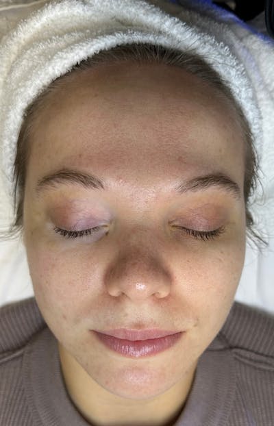 Acne Treatment Before & After Gallery - Patient 326187 - Image 2