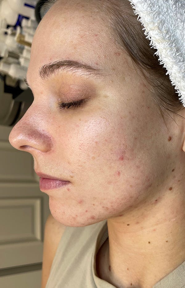 Acne Treatment Before & After Gallery - Patient 326187 - Image 3